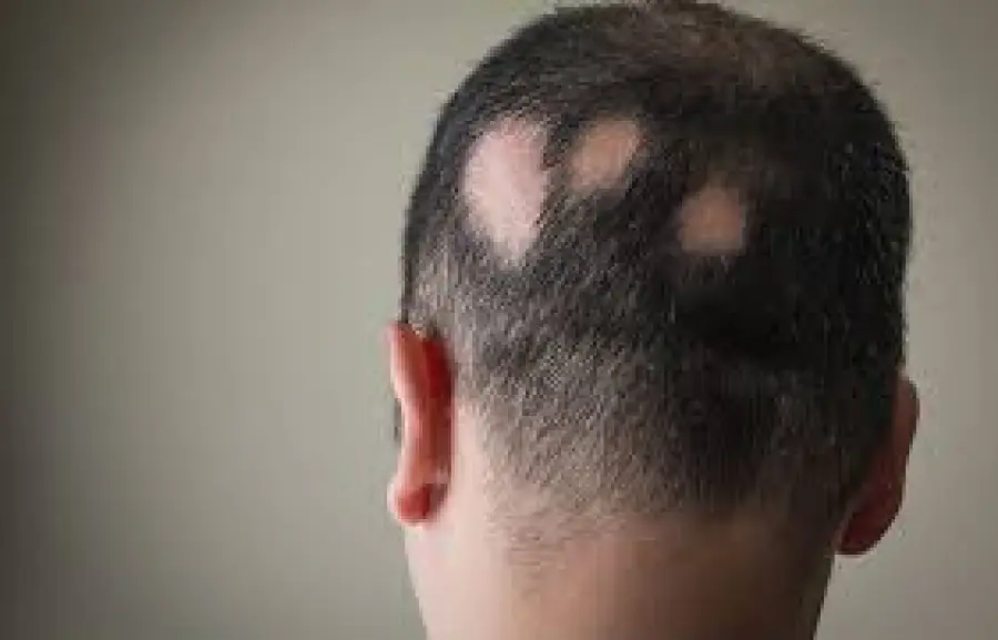 Alopecia cos'è? Sintomi e cura