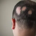 Alopecia cos'è? Sintomi e cura