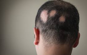 Alopecia cos’è? Sintomi e cura